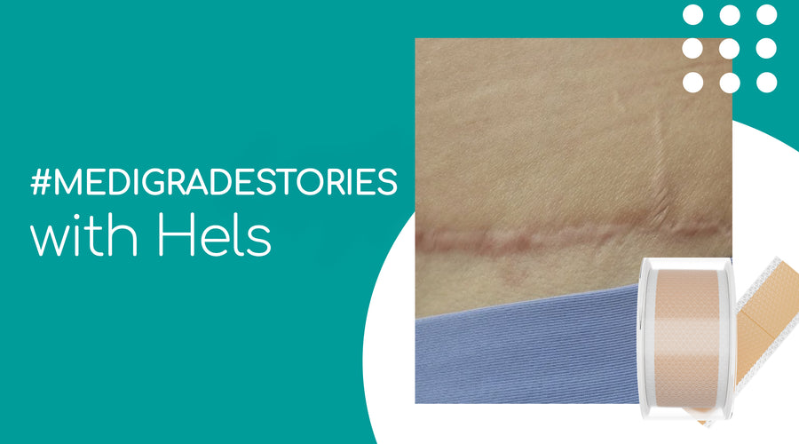 #MEDIGRADESTORIES: THE LIFE-CHANGING EXPERIENCE AFTER A TUMMY TUCK