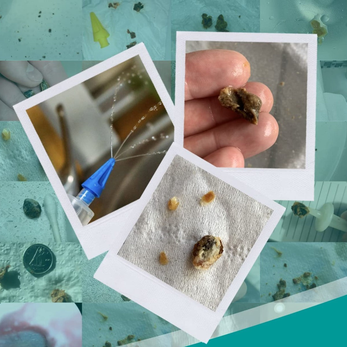 Collage of images of earwax removed