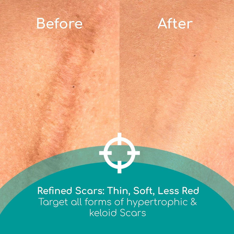 Before and After photo of a scar